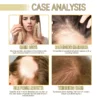 EELHOE Rosemary Oil Grows Hair Loss Treatment Bald Head Hair Regrowth Moisturizing Hair Scalp Massager Rosemary Essential Oil