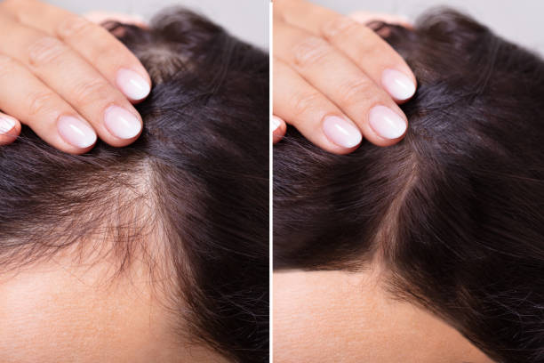 hair growth before and after