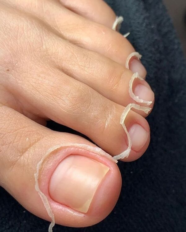 “Fungus Hack Reviews: Does It Really Work for Toenail Fungus?