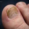 “Fungus Hack Reviews: Does It Really Work for Toenail Fungus?