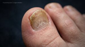“Fungus Hack Reviews: Does It Really Work for Toenail Fungus?