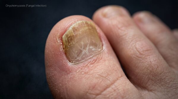 “Fungus Hack Reviews: Does It Really Work for Toenail Fungus?