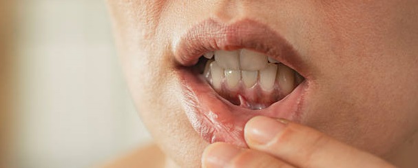 what causes bad breath even after brushing