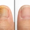 shocking nail fungus results