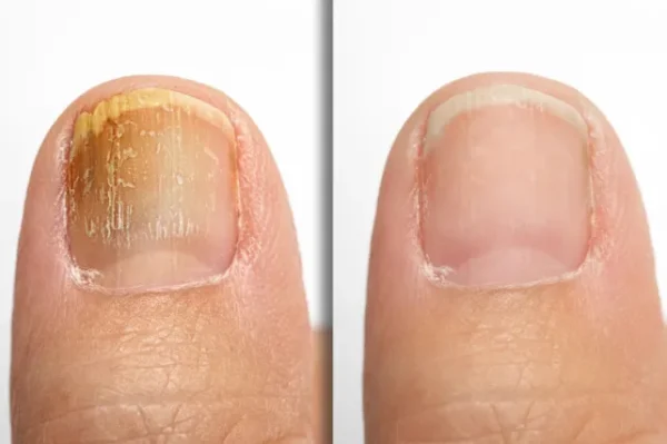 shocking nail fungus results