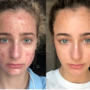 fade dark spots naturally