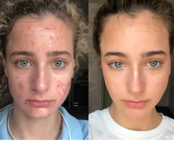 fade dark spots naturally