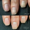 How to get rid of toenail fungus naturally