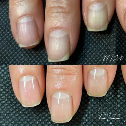 How to get rid of toenail fungus naturally