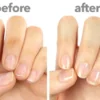 stop stubborn fungal infections