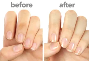 stop stubborn fungal infections