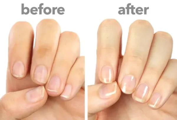 stop stubborn fungal infections