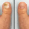 How to get rid of toenail fungus naturally