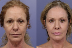 Synevra UltraLift reviews